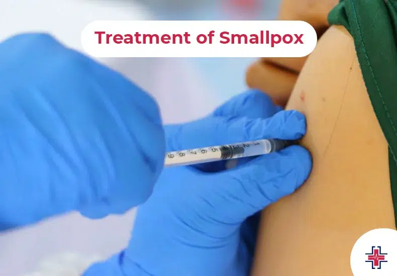 Treatment of Smallpox - ER of Mesquite