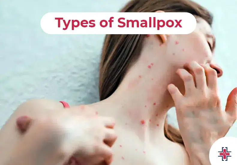 Types of Smallpox - ER of Mesquite