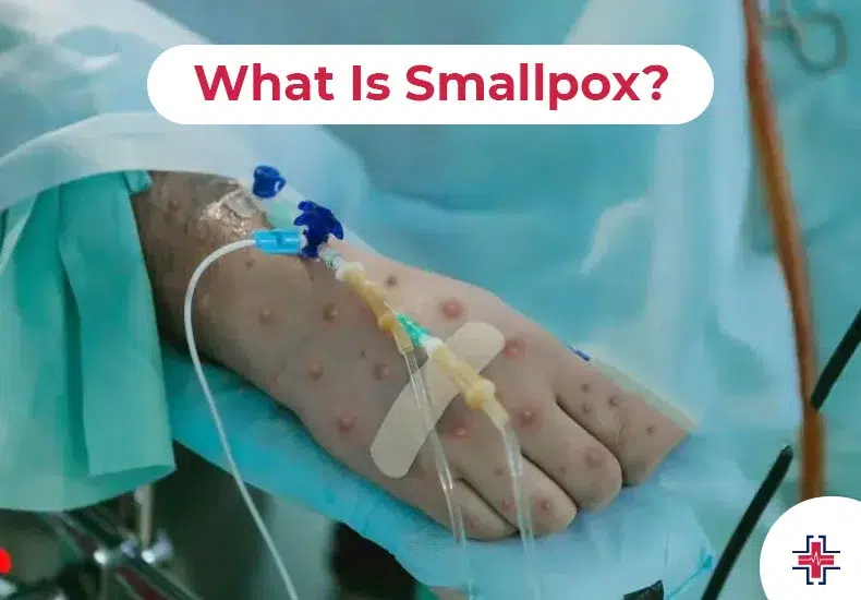 What Is Smallpox - ER of Mesquite