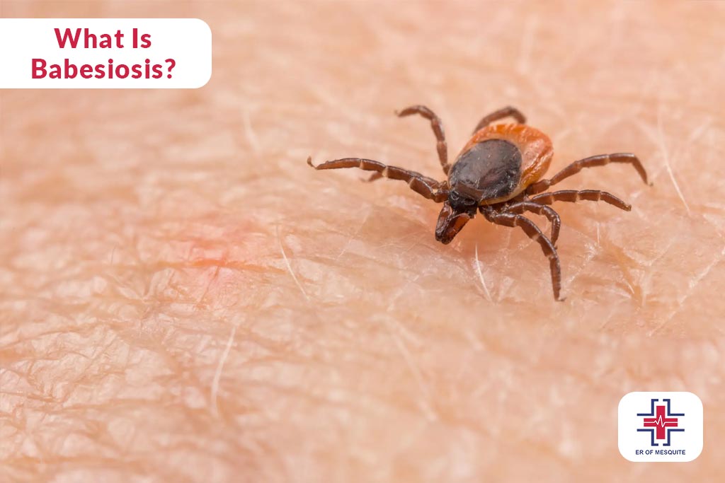 What is Babesiosis - ER of Mesquite