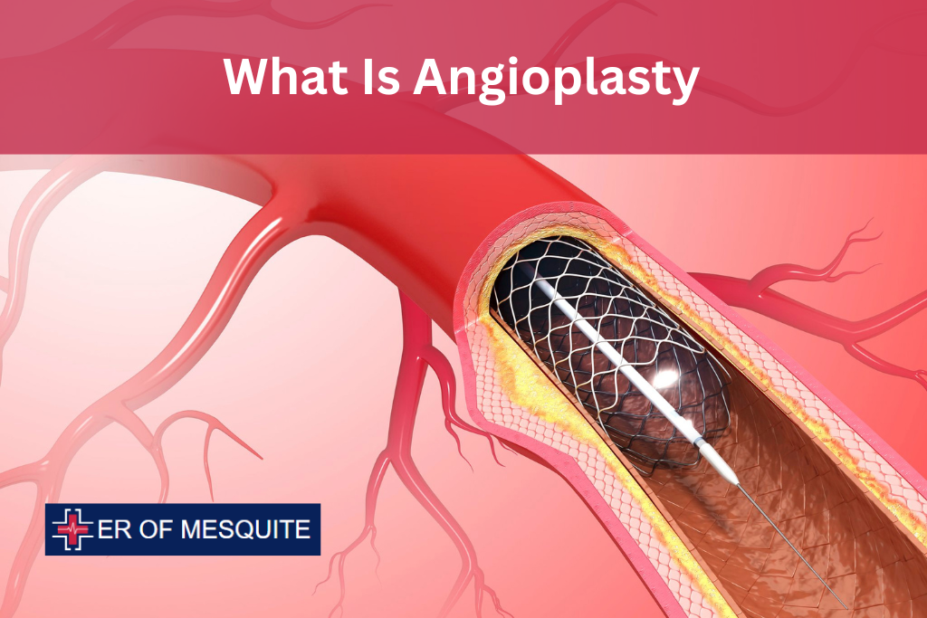 What Is Angioplasty - ER of Mesquite