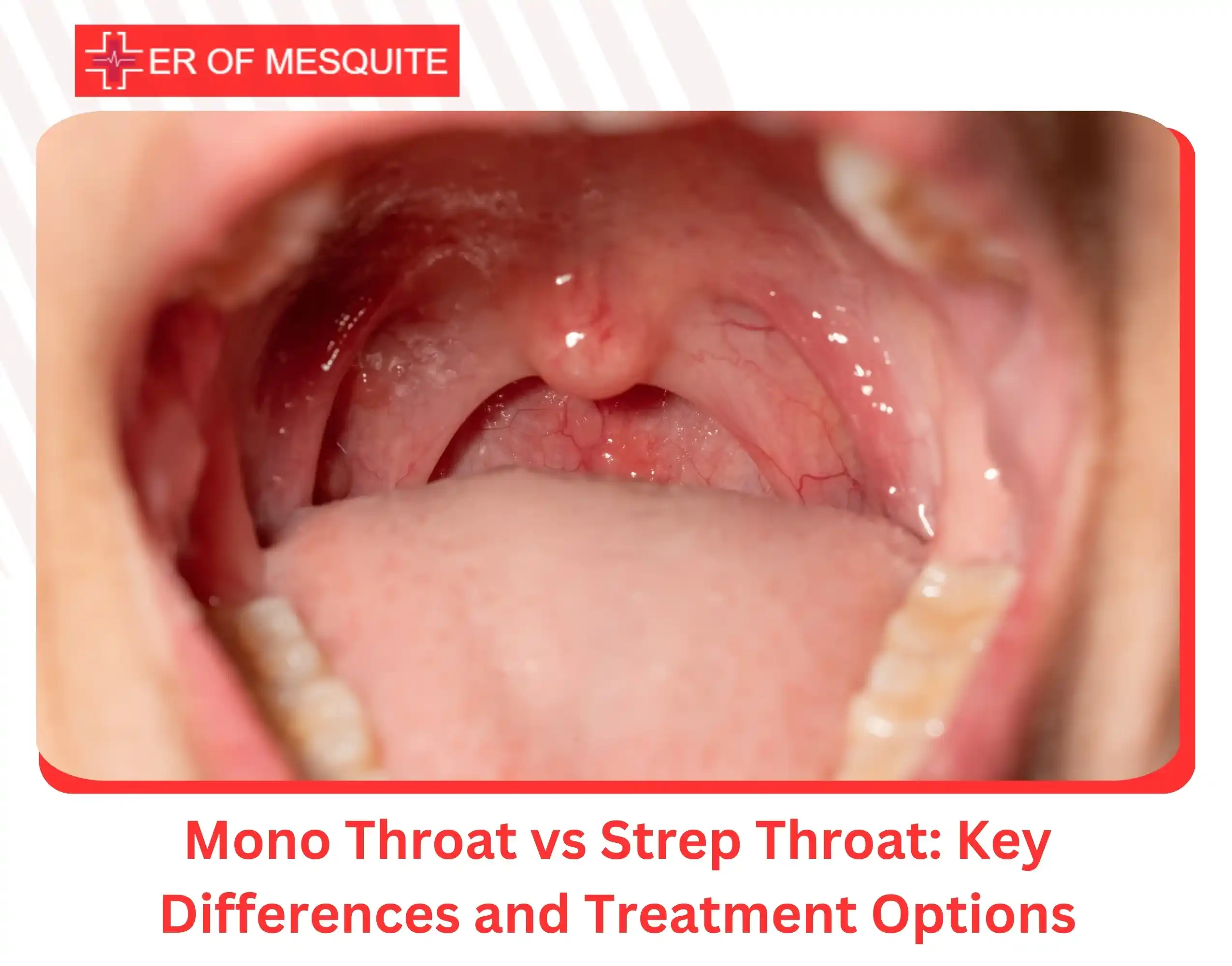 Mono Throat vs Strep Throat Key Differences and Treatment Options