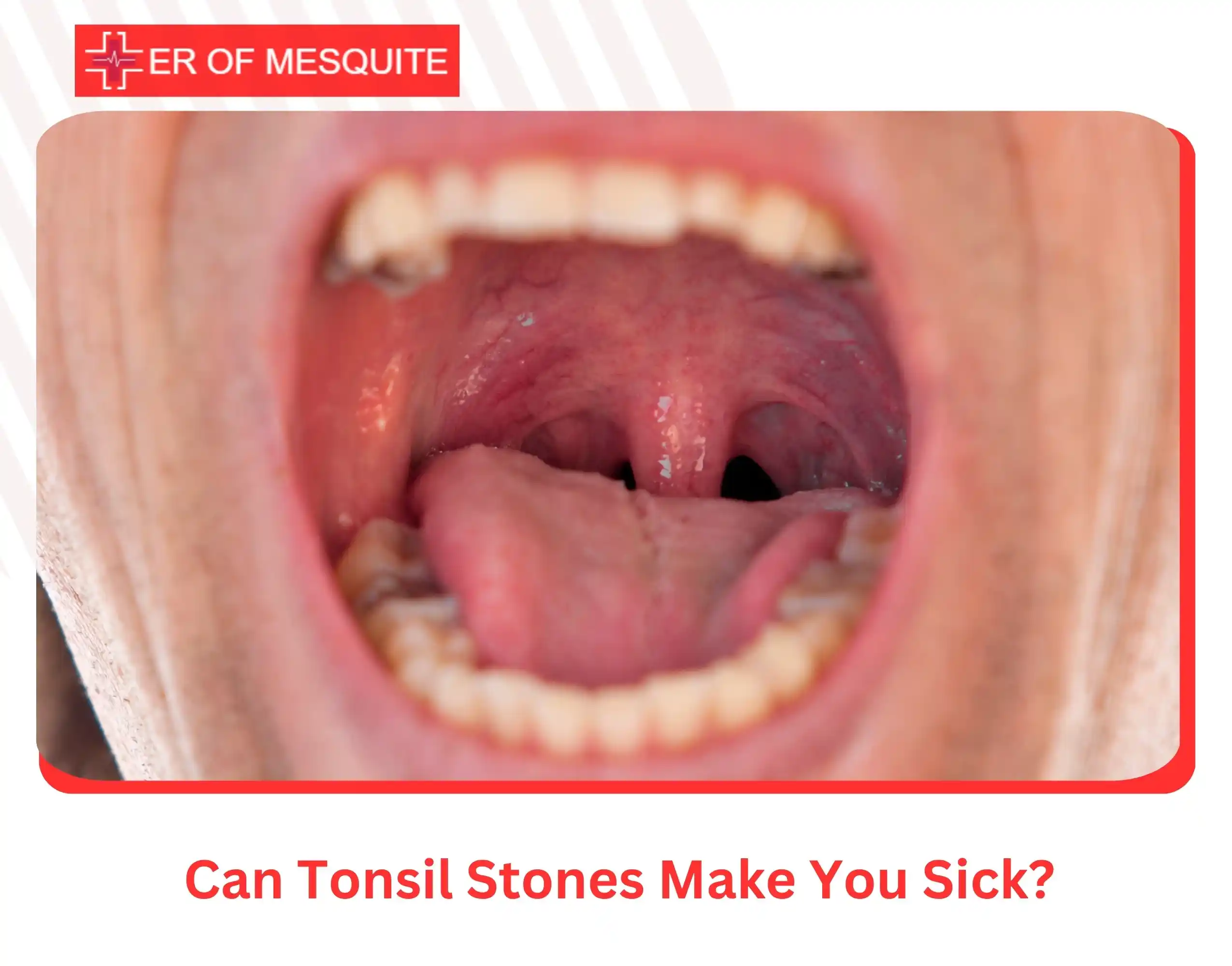 Can Tonsil Stones Make You Sick