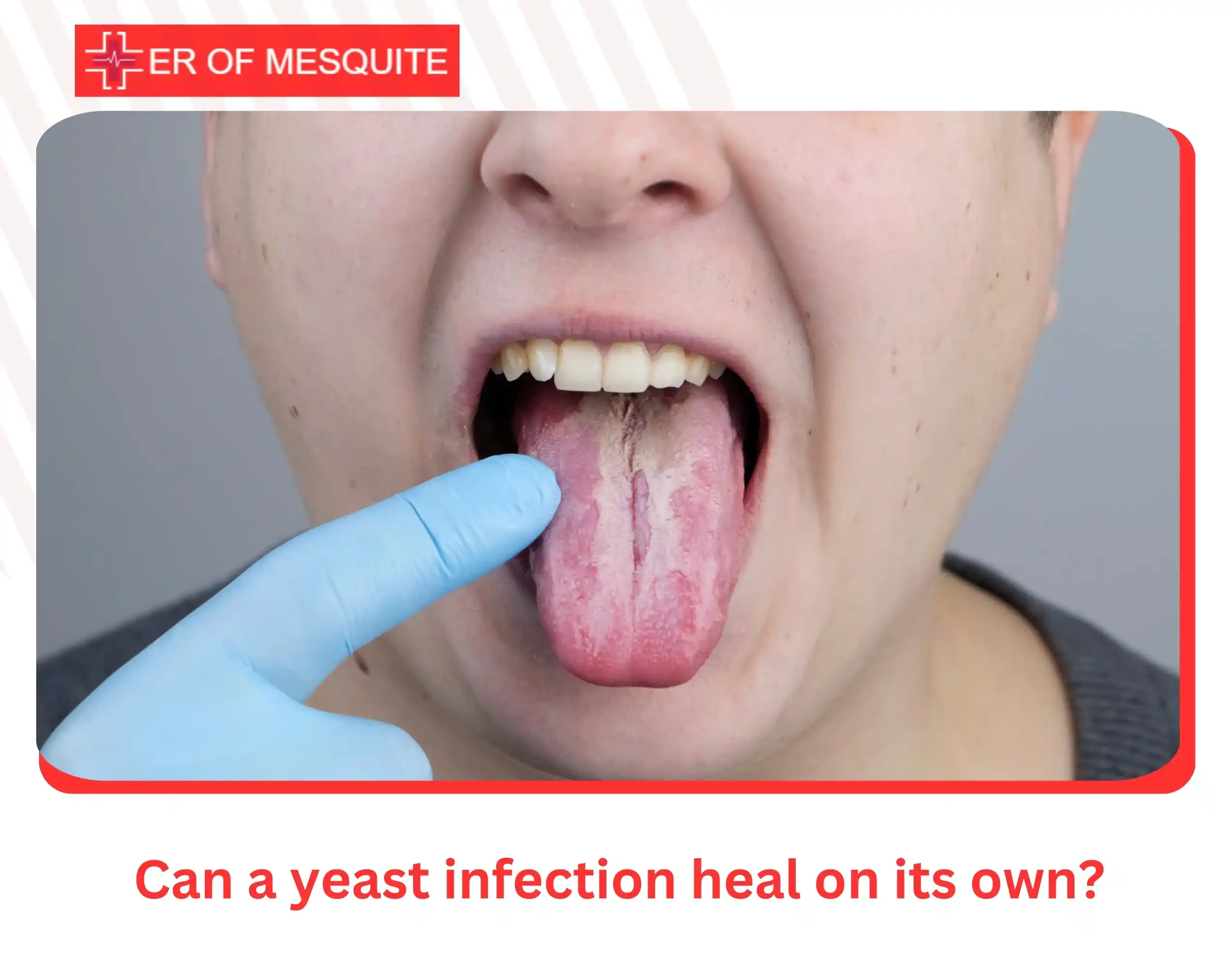 Can a yeast infection heal on its own