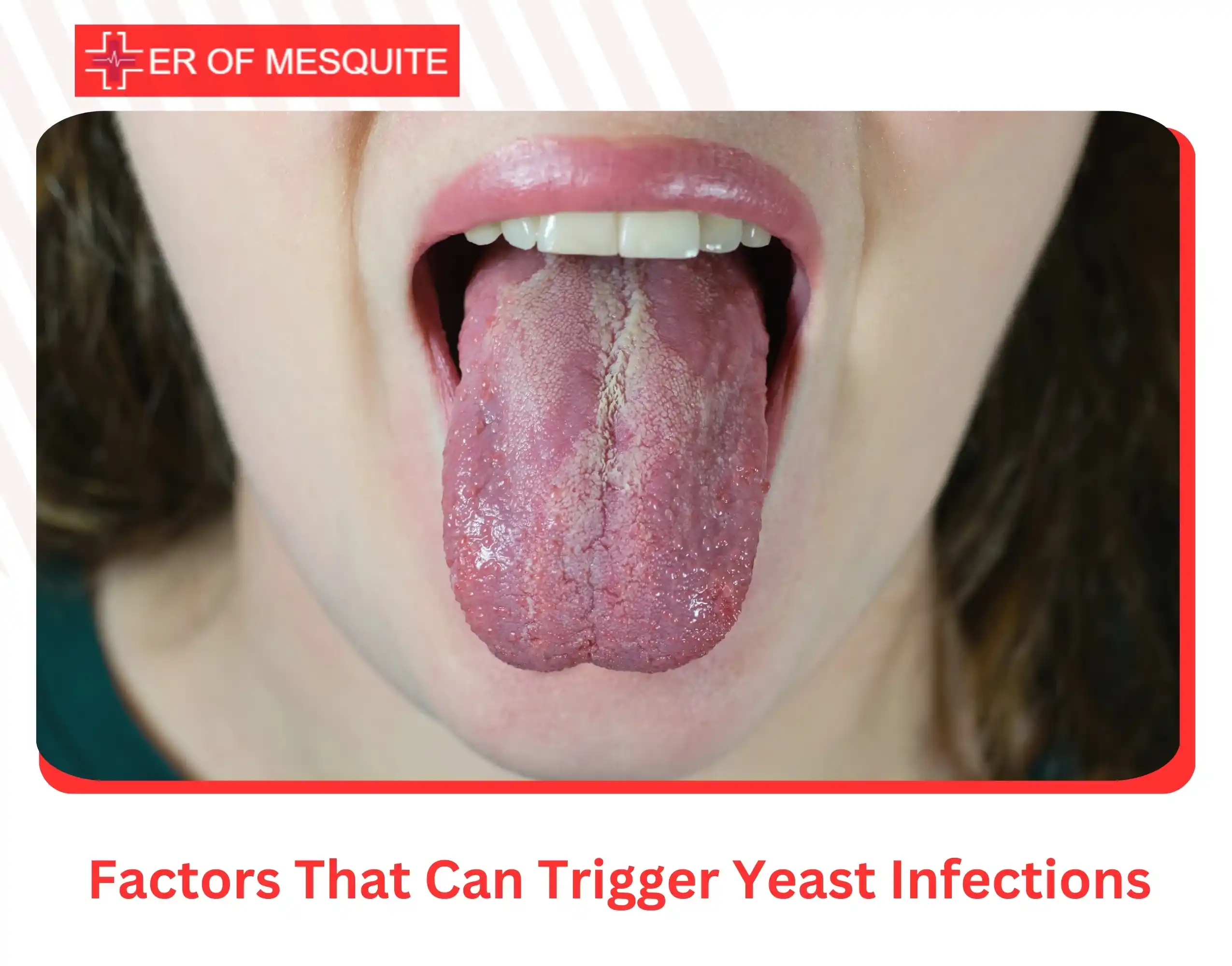 Factors That Can Trigger Yeast Infections