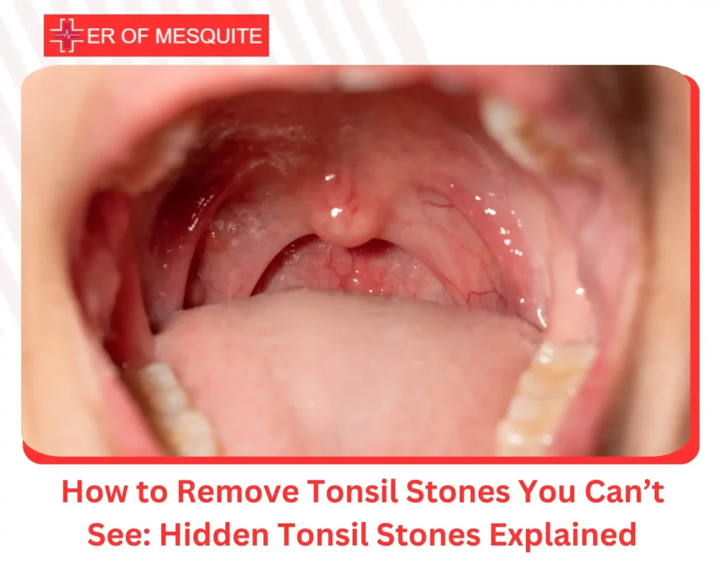 How to Remove Tonsil Stones You Can’t See Hidden Tonsil Stones Explained