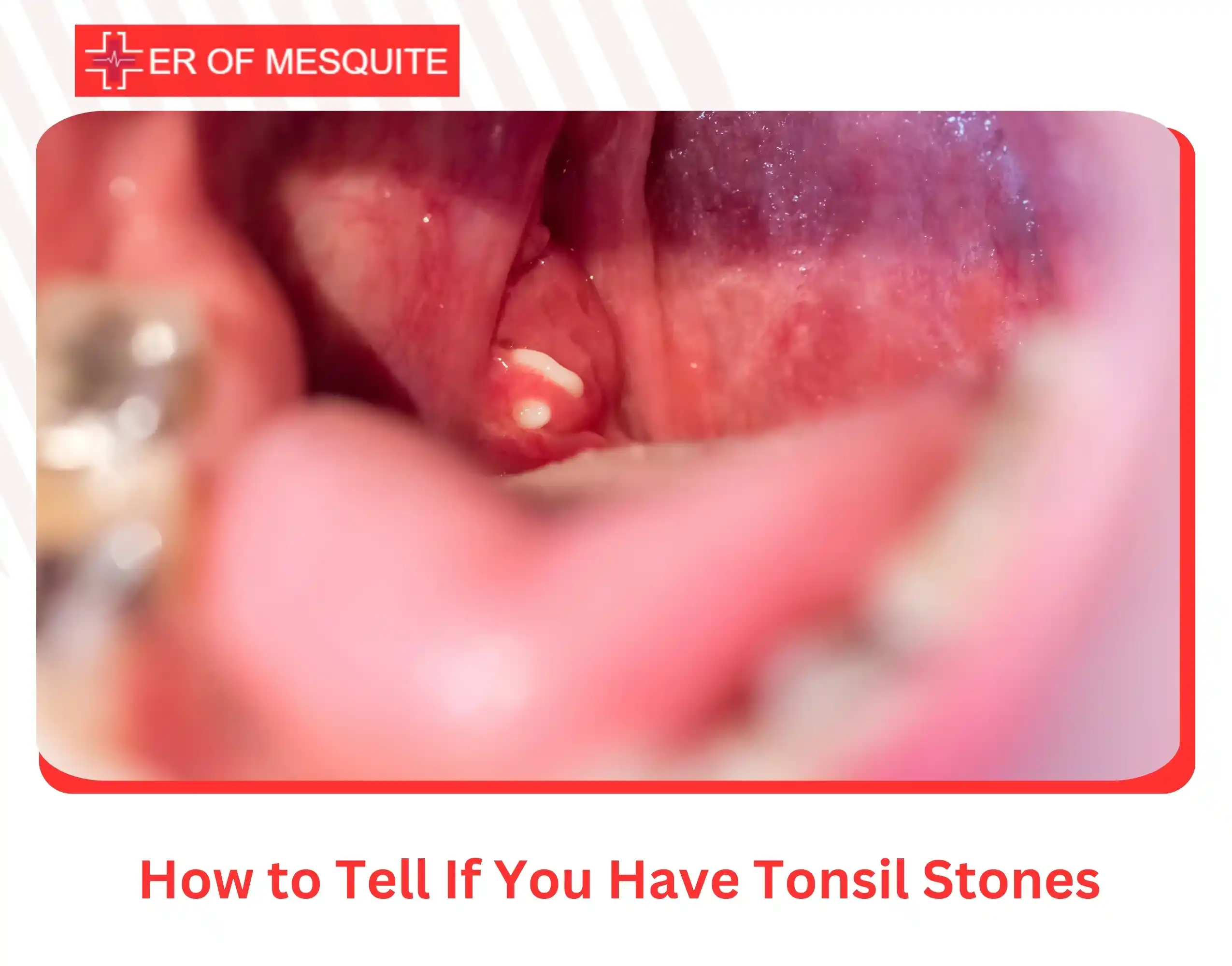 How to Tell If You Have Tonsil Stones