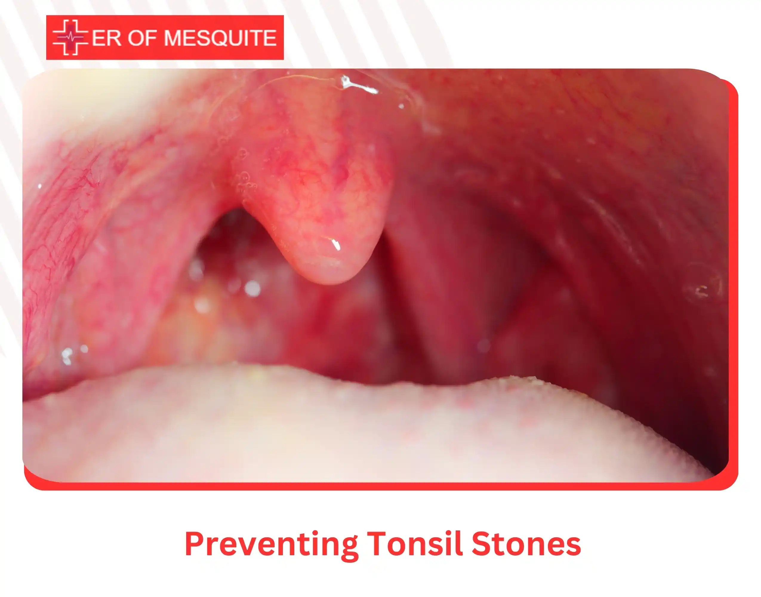 Preventing Tonsil Stones