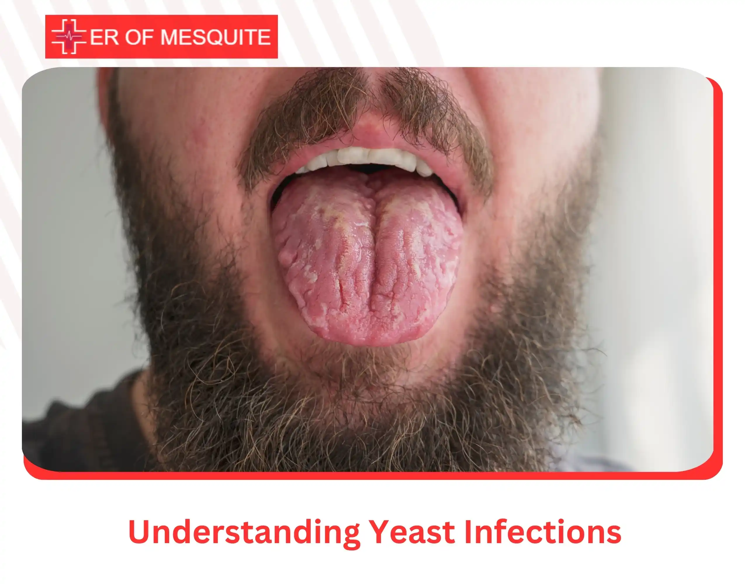Understanding Yeast Infections