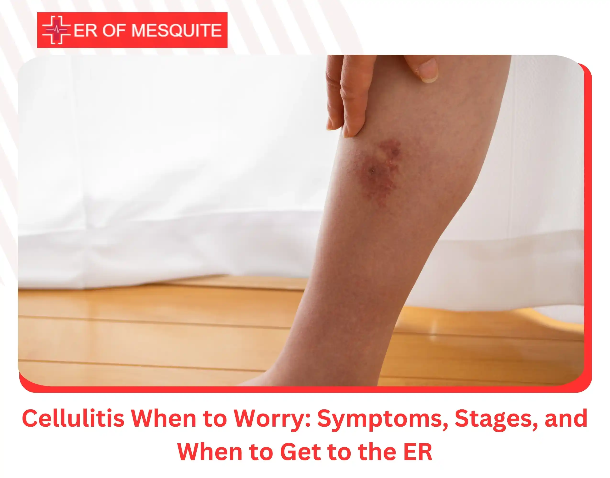 Cellulitis When to Worry Symptoms, Stages, and When to Get to the ER
