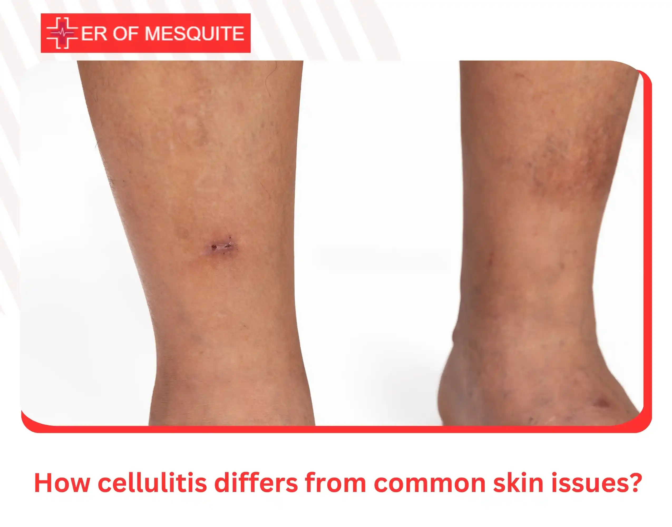 How cellulitis differs from common skin issues