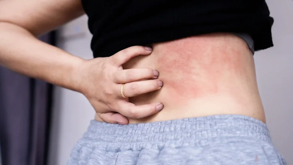 Rashes