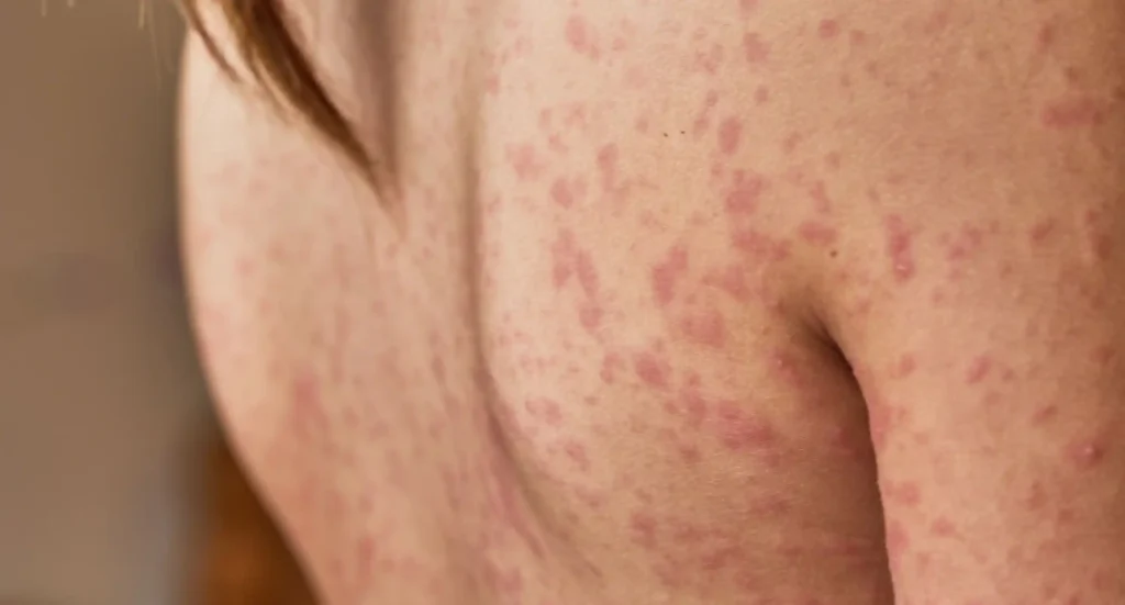 Rashes