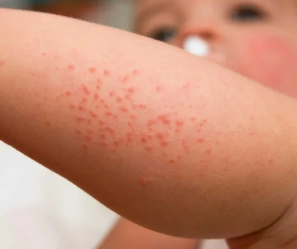 Rashes