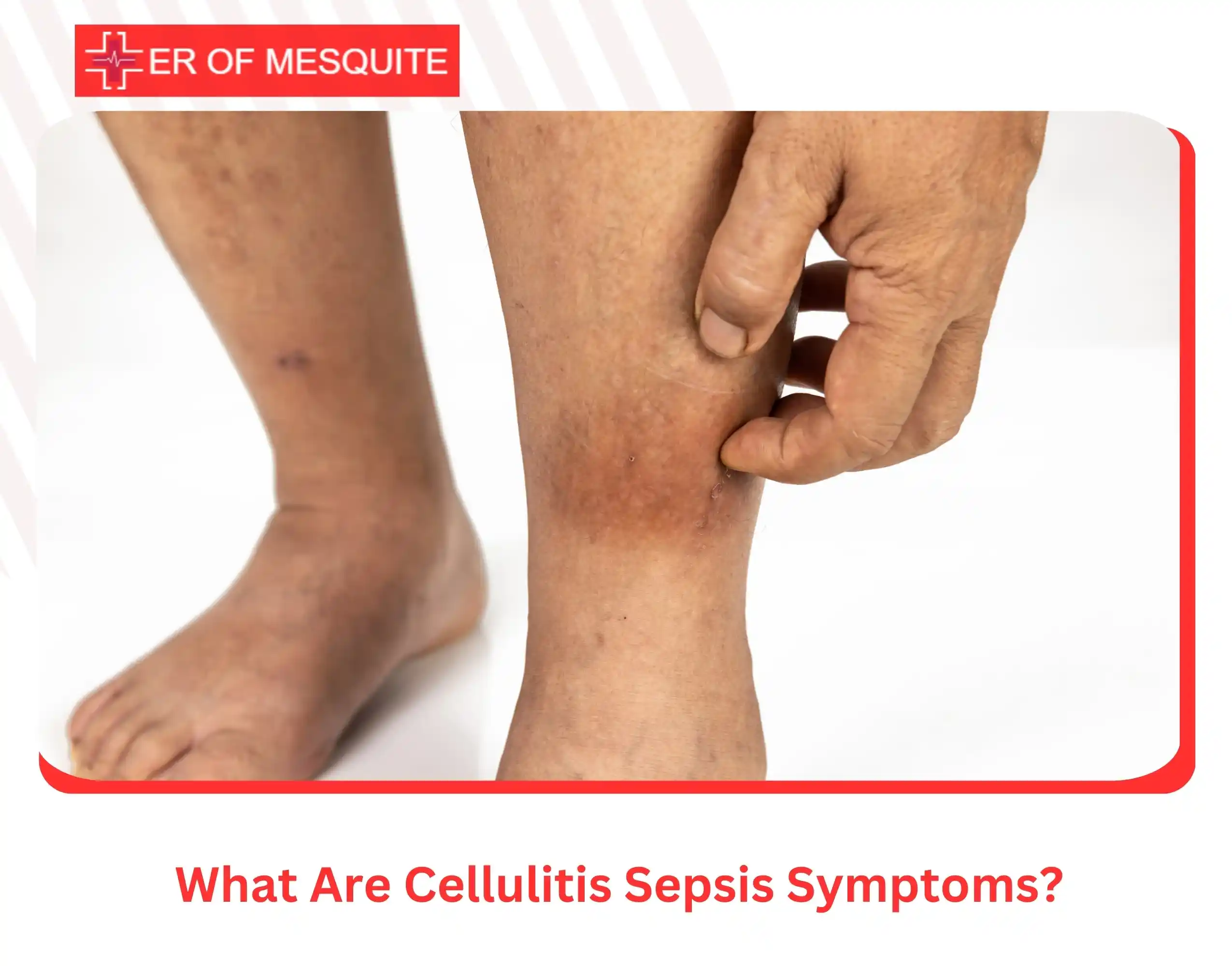 What Are Cellulitis Sepsis Symptoms