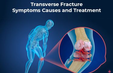 Transverse Fracture - Symptoms, Causes and Treatment - ER of Mesquite